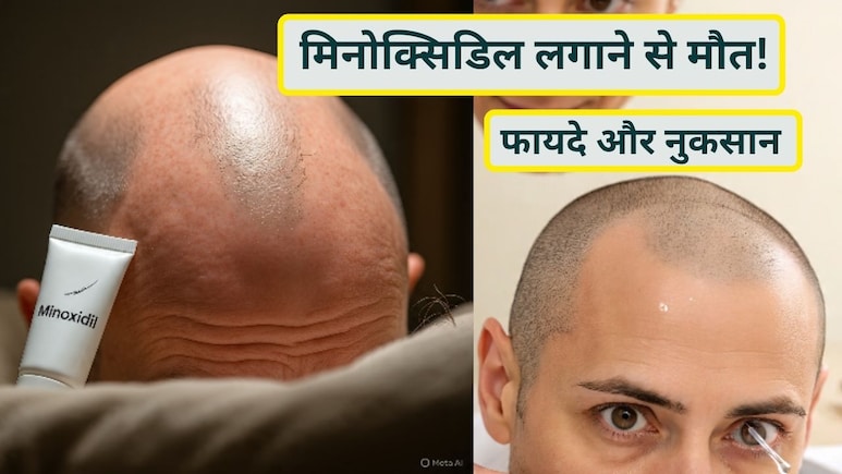 मिनोक्सिडिल लगाने से मौत! जानें Minoxidil कैसे काम करता है, इसके फायदे और नुक्सान