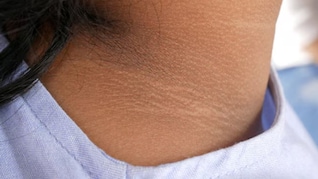 काली पड़ गई है गर्दन कैसे करुं साफ? जानिए यहां 3 जबरदस्त असरदार नुस्खा, 1 बार में हो जाएगा साफ