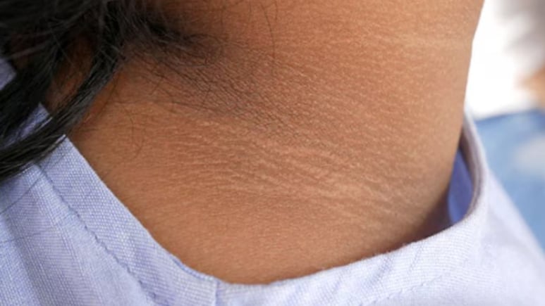 काली पड़ गई है गर्दन कैसे करुं साफ? जानिए यहां 3 जबरदस्त असरदार नुस्खा, 1 बार में हो जाएगा साफ