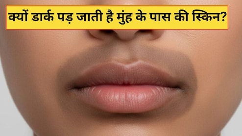 होंठों के आसपास का कालापन कैसे दूर करें? स्किन की डॉक्टर ने बताई क्यों डार्क पड़ जाती है मुंह के पास की स्किन