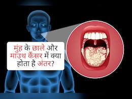 सावधान! अगर 2 हफ्ते से ज्यादा रहता है मुंह का छाला, तो ये मामूली बात नहीं, जानें कैंसर और छालों में फर्क