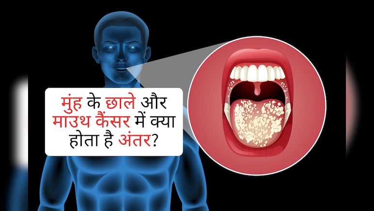 सावधान! अगर 2 हफ्ते से ज्यादा रहता है मुंह का छाला, तो ये मामूली बात नहीं, जानें कैंसर और छालों में फर्क