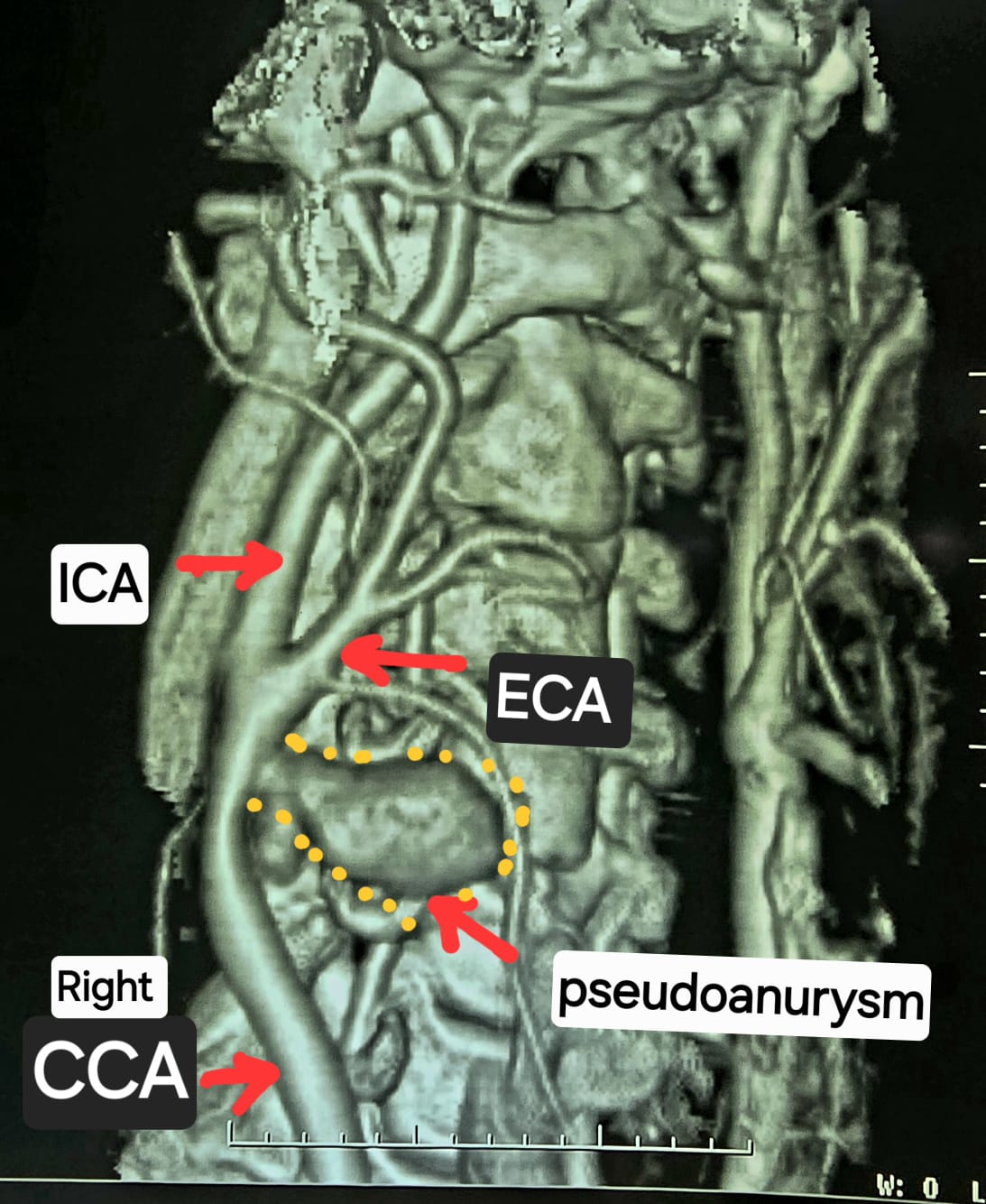 गर्दन की रक्त वाहिकाओं की सीटी एंजियोग्राफी में दाईं कॉमन कैरोटिड आर्टरी के बाइफरकेशन पर स्यूडोएन्यूरिज्म दिखाई दे रहा है.