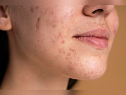 चेहरे पर लाल रंग के पिंपल हो जाएं तो क्या करें? आयुर्वेदिक न्यूट्रिशनिस्ट ने बताया सबसे असरदार नुस्खा, एकदम क्लियर हो जाएगी स्किन