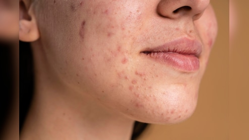 चेहरे पर लाल रंग के पिंपल हो जाएं तो क्या करें? आयुर्वेदिक न्यूट्रिशनिस्ट ने बताया सबसे असरदार नुस्खा, एकदम क्लियर हो जाएगी स्किन