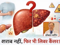 शराब नहीं पीते, फिर भी लिवर कैंसर का खतरा, 50 साल अनुभव वाले लिवर स्पेशलिस्ट डॉ. सरीन ने बताया अलसी कारण