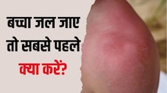 बच्चे पर गर्म पानी गिर जाए तो क्या करें? डॉक्टर ने बताया तुरंत क्या लगाएं और क्या नहीं