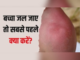 बच्चे पर गर्म पानी गिर जाए तो क्या करें? डॉक्टर ने बताया तुरंत क्या लगाएं और क्या नहीं