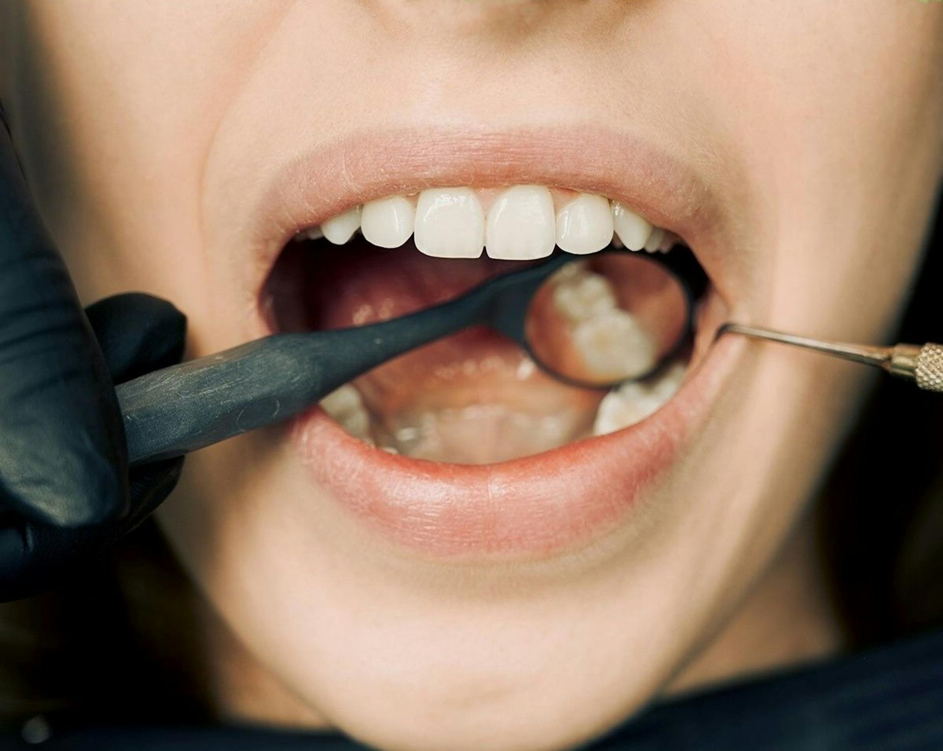 Your Mouth Bacteria Can Predict Risk Of Chronic Liver Disease: Study