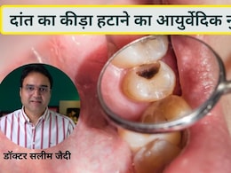 डॉक्टर ने बताया दांत में कीड़ा, दर्द और सड़न का असरदार आयुर्वेदिक नुस्खा, बस घर पर इस चीज से बनाएं माउथ वॉश