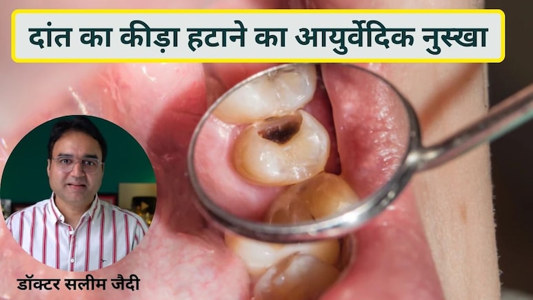 डॉक्टर ने बताया दांत में कीड़ा, दर्द और सड़न का असरदार आयुर्वेदिक नुस्खा, बस घर पर इस चीज से बनाएं माउथ वॉश