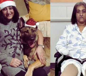 पाळीव कुत्र्याने प्रेमाने चाटलं अन् महिलेने गमावले हात-पाय; उपचारादरम्यान 6 वेळा हृदयविकाराचा झटका