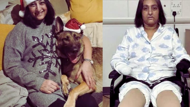 पाळीव कुत्र्याने प्रेमाने चाटलं अन् महिलेने गमावले हात-पाय; उपचारादरम्यान 6 वेळा हृदयविकाराचा झटका