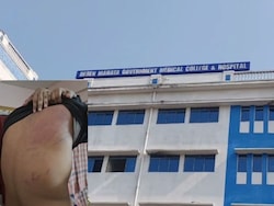 Student Assaulted, Massive Bruises On Back In Bengal Medical College Ragging