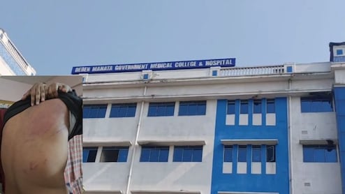 Student Assaulted, Massive Bruises On Back In Bengal Medical College Ragging