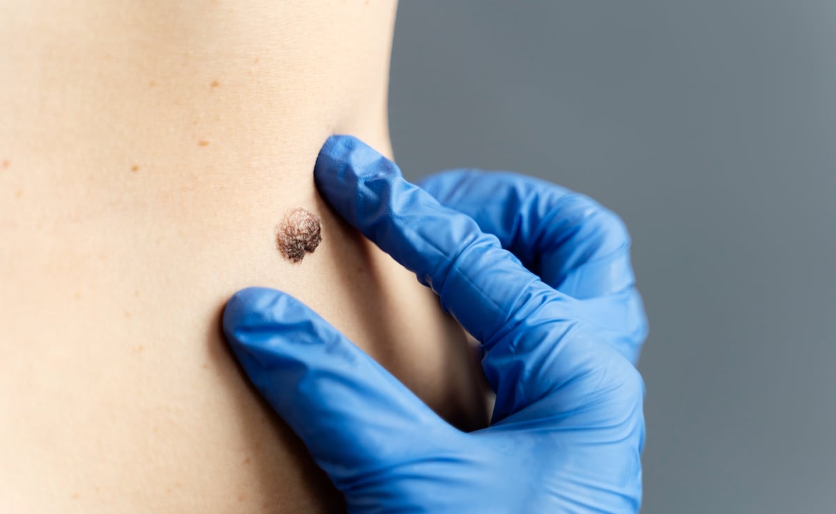 A doctor measuring a skin mole