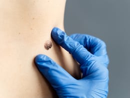 ABCDE Rule To Detect Skin Cancer Before It's Too Late