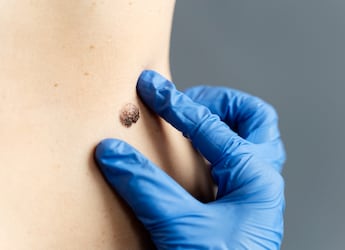 ABCDE Rule To Detect Skin Cancer Before It's Too Late