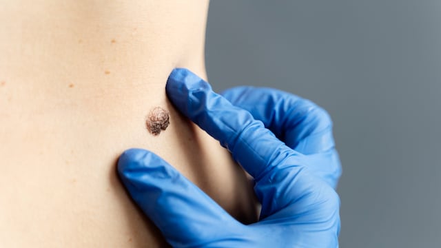 Skin cancer does not always announce itself through pain