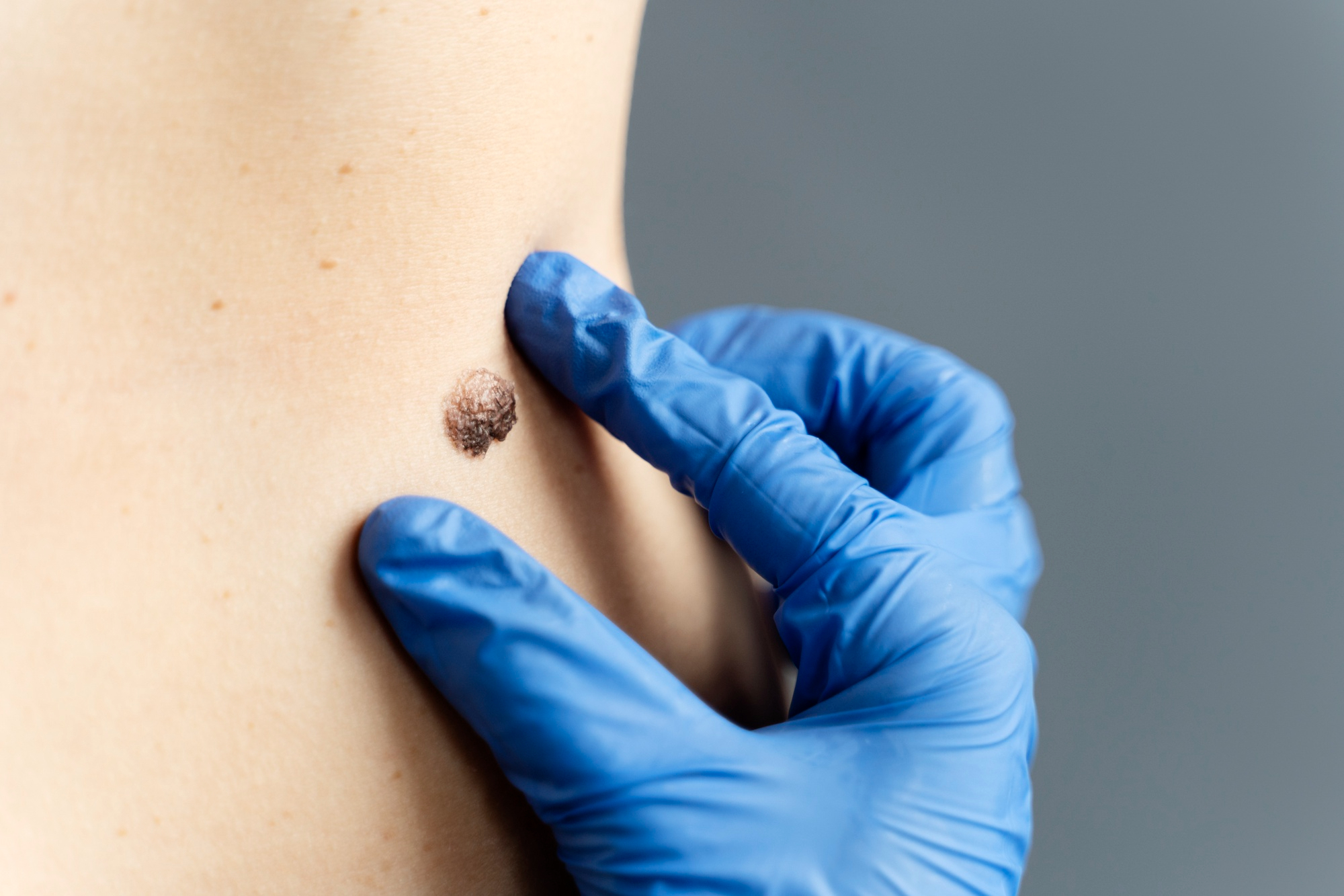 Skin cancer does not always announce itself through pain