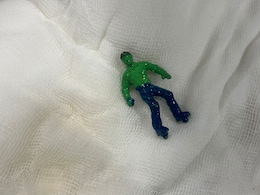 Gujarat Toddler Swallows 'Hulk', A Complicated Procedure Follows