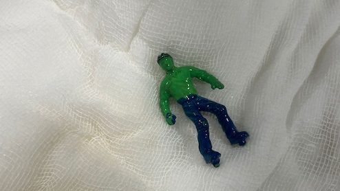 Gujarat Toddler Swallows 'Hulk', A Complicated Procedure Follows