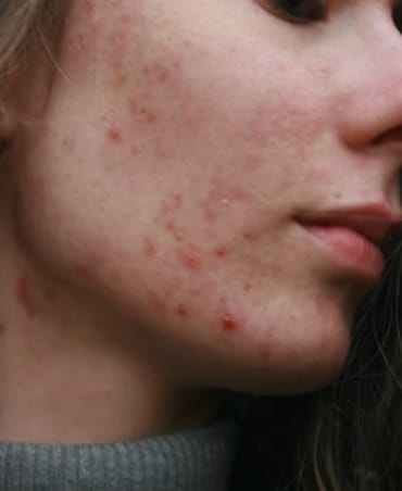 Best Foods That Fight Acne