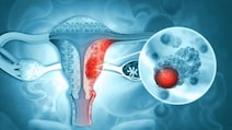 India's First Indigenous HPV Test Validated For Cervical Cancer Detection