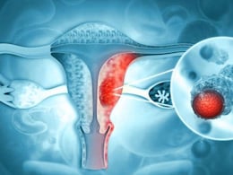 India's First Indigenous HPV Test Validated To Make Cervical Cancer Detection Affordable