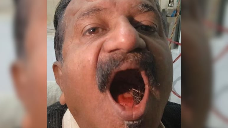 इंसान या 'आयरन मैन'? 45 सालों से अपने मुंह में नुकीली पिनों का जखीरा लेकर घूम रहा शख्स