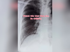 सांस के साथ फेफड़ों तक चली गई नोज़ पिन, एक्स-रे देख डॉक्टर के उड़े होश, मसां-मसां बची जान