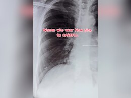 सांस के साथ फेफड़ों तक चली गई नोज़ पिन, एक्स-रे देख डॉक्टर के उड़े होश, मसां-मसां बची जान