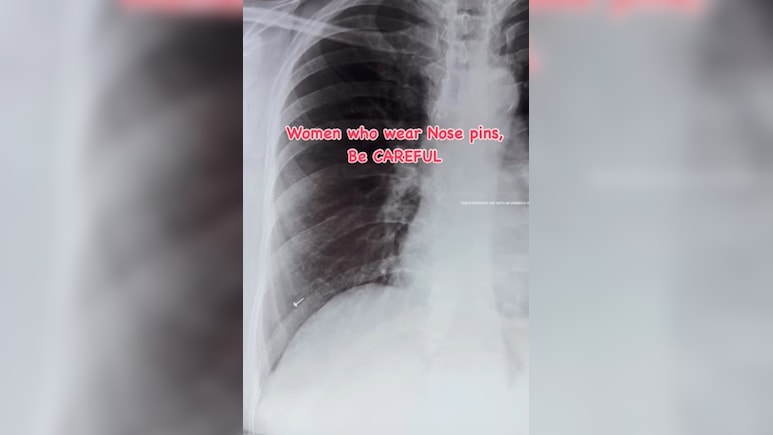 सांस के साथ फेफड़ों तक चली गई नोज़ पिन, एक्स-रे देख डॉक्टर के उड़े होश, मसां-मसां बची जान