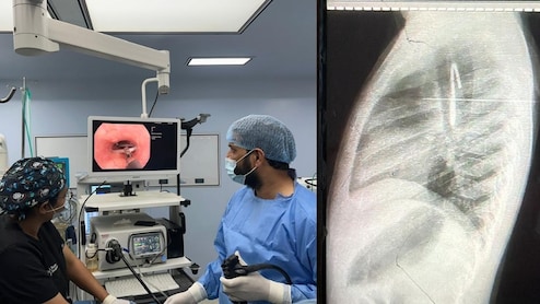 बच्ची ने निगल लिया था लोहे का हुक, जान पर आफत, फिर सरकारी डॉक्टरों ने बिना ऑपरेशन कर दिया कमाल!