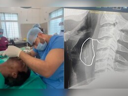 युवक के गले में फंसी चिकन की हड्डी! डॉक्टरों ने सर्जरी कर निकाली, मुश्किल से बच पाई जान