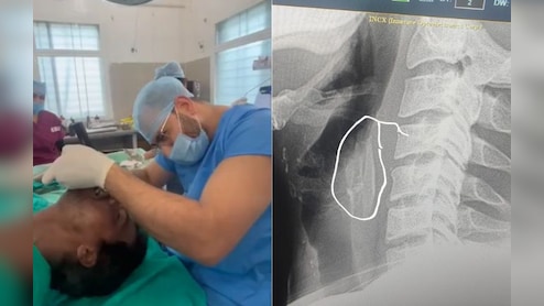 युवक के गले में फंसी चिकन की हड्डी! डॉक्टरों ने सर्जरी कर निकाली, मुश्किल से बच पाई जान
