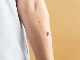 Doctor Explains Why A Skin Cancer Check Is Important And How To Know If Your Mole Is A Problem?