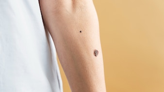Skin Cancer Check: How To Know If Your Mole Is A Problem?