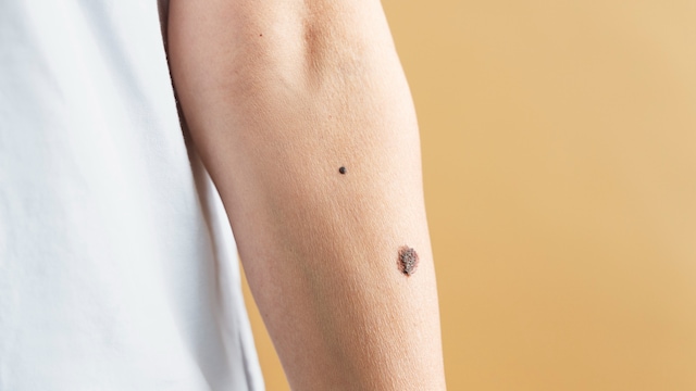 Moles are common occurrences that require monitoring for safety