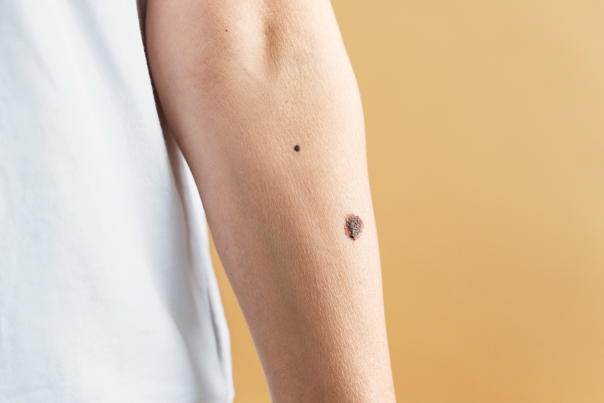 Moles are common occurrences that require monitoring for safety