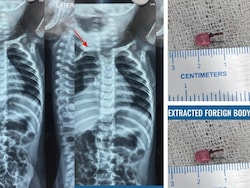 LED Bulb Found In 1-Year-Old Gujarat Boy's Windpipe After Weeks Of Illness