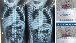 LED Bulb Found In 1-Year-Old Gujarat Boy's Windpipe After Weeks Of Illness