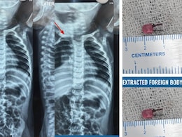 LED Bulb Found In 1-Year-Old Gujarat Boy's Windpipe After Weeks Of Illness