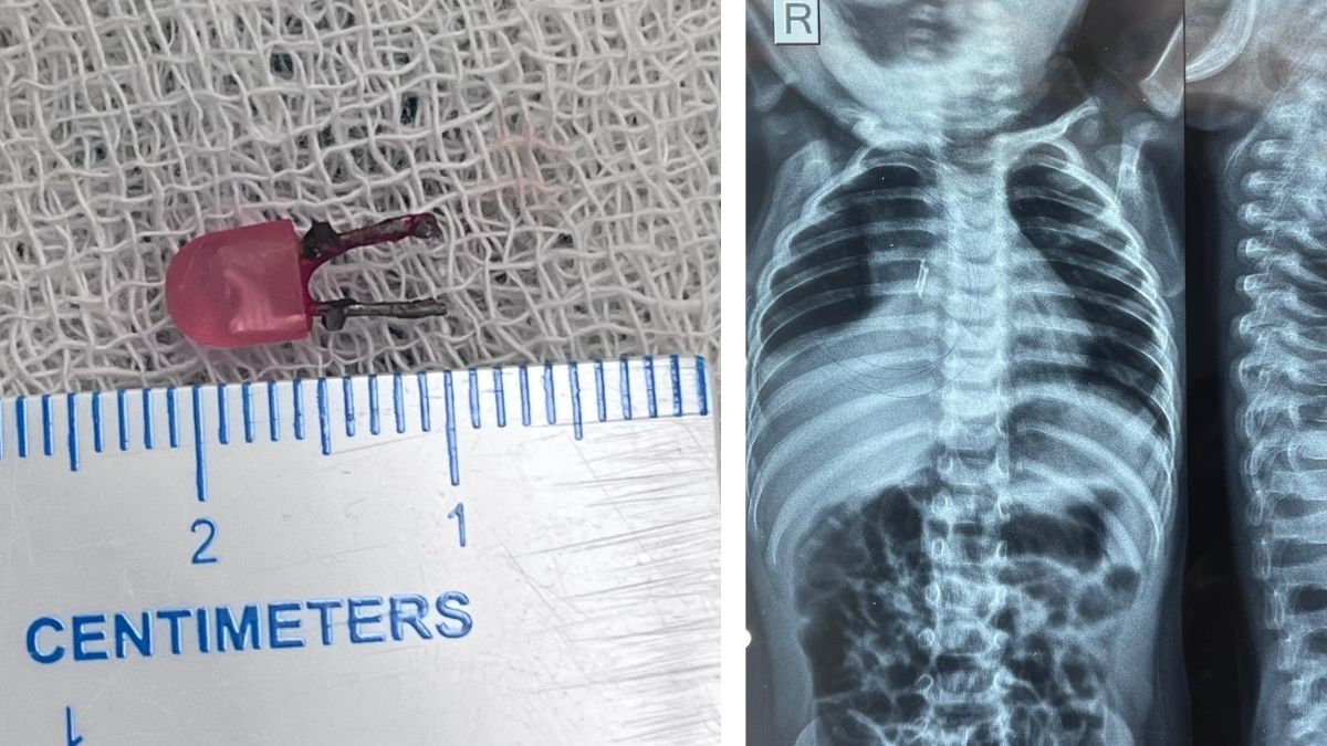 खेल-खेल में निगल गया LED बल्ब, डॉक्टरों ने ऑपरेशन से ऐसे बचाई मासूम की जान,देखें VIDEO