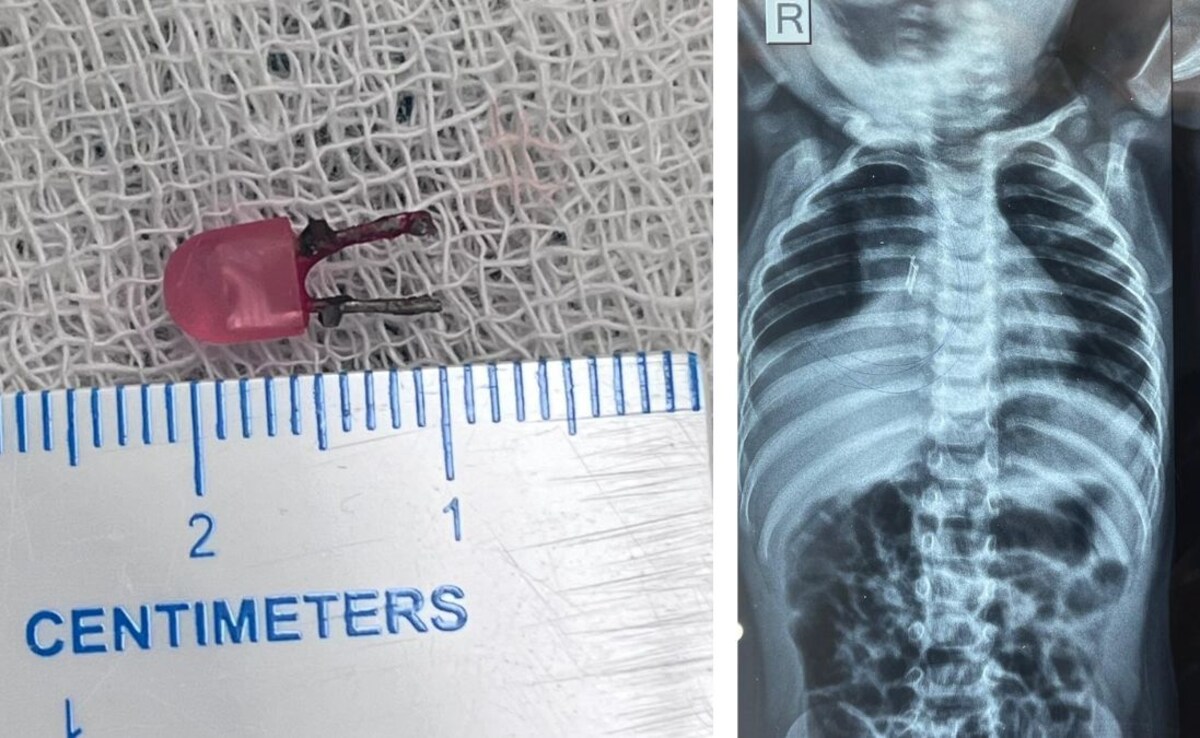 खेल-खेल में निगल गया LED बल्ब, डॉक्टरों ने ऑपरेशन से ऐसे बचाई मासूम की जान,देखें VIDEO