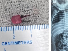 खेल-खेल में निगल गया LED बल्ब, डॉक्टरों ने ऑपरेशन से ऐसे बचाई मासूम की जान,देखें VIDEO