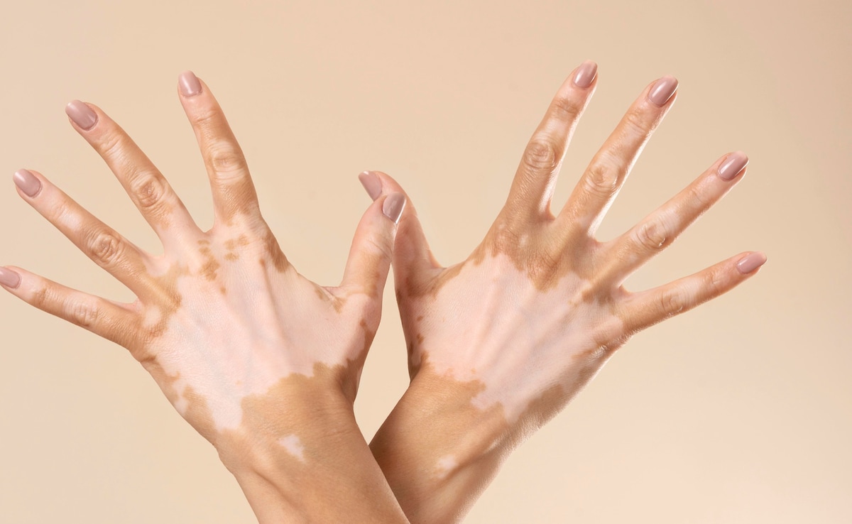 7 Skin Signs That May Reveal Diabetes Risk Early