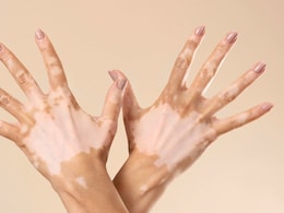 7 Skin Signs That May Reveal Diabetes Risk Early