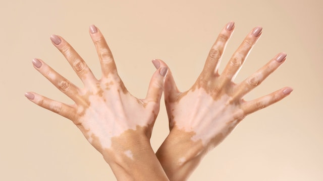 Your skin is a mirror of your metabolic health and signs on it could indicate diabetes risk