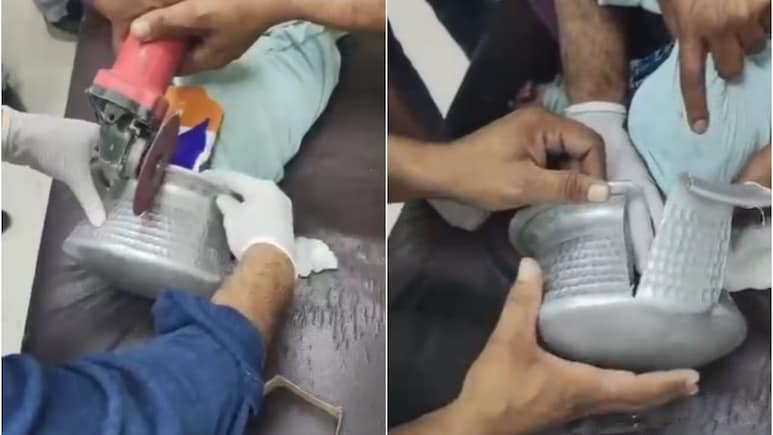 VIDEO: बर्तन में फंसा बच्&zwj;चे का सिर, चीखता-चिल्लाता रहा मासूम, घंटों बाद डॉक्टरों ने यूं बचाई जान